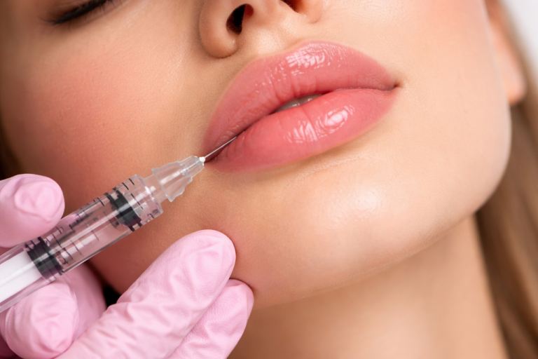 Unterspritzung Lippen